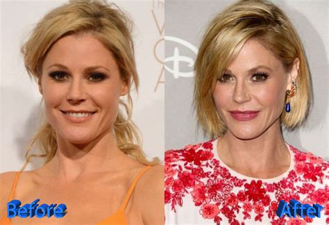 julie bowen face surgery